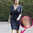 Kim Kardashain hat eine aufgeschürfte Stelle am Bein 