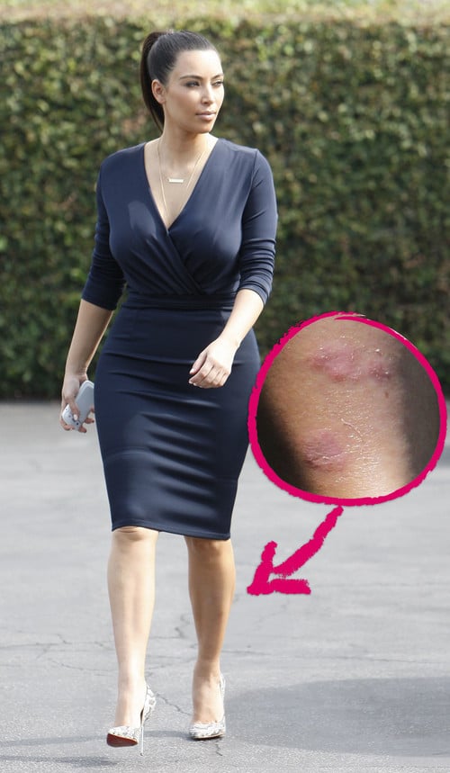 Kim Kardashain hat eine aufgeschürfte Stelle am Bein Kim Kardashain hat eine aufgeschürfte Stelle am Bein