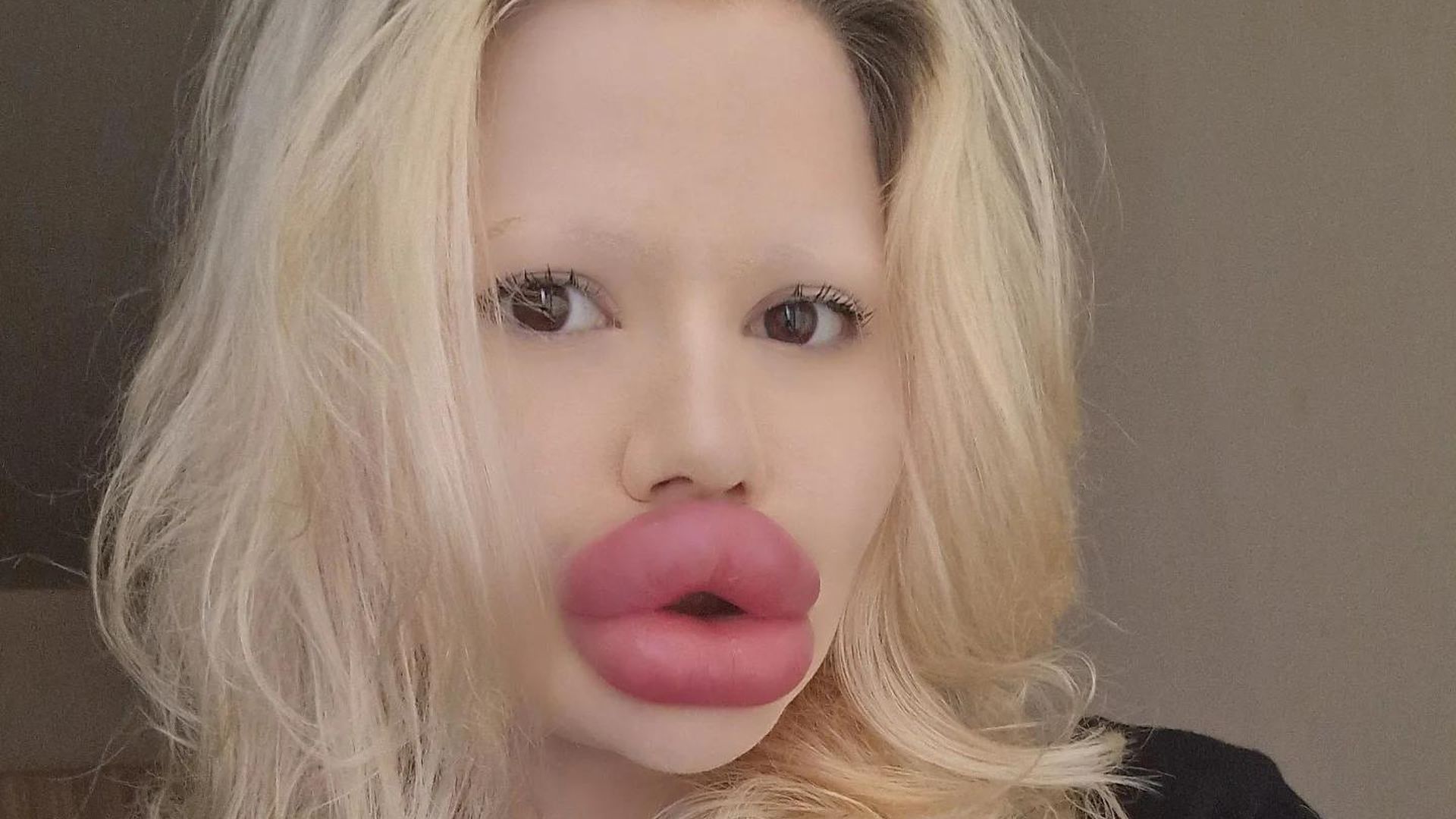 Neben-XXL-Lippen-Andrea-Ivanova-plant-neue-Beauty-Projekte