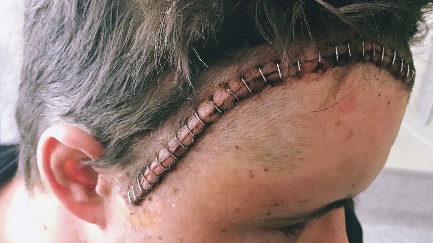 Johnny Ruffos getackerte OP-Narbe