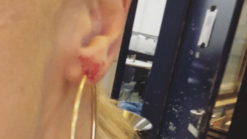 Kathrin Menzinger zeigt ihr verletztes Ohr