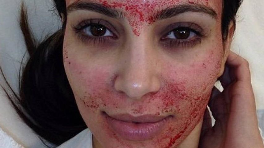 Kim Kardashian nach einem Vampir-Lifting 2013