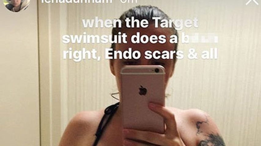 Lena Dunham zeigt ihre Narben