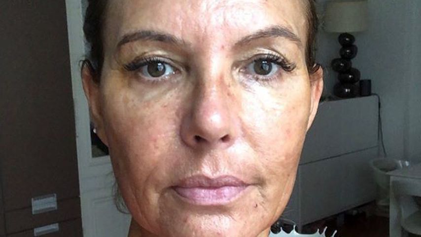 Falten-Kampf: Natascha Ochsenknecht bei blutiger Behandlung