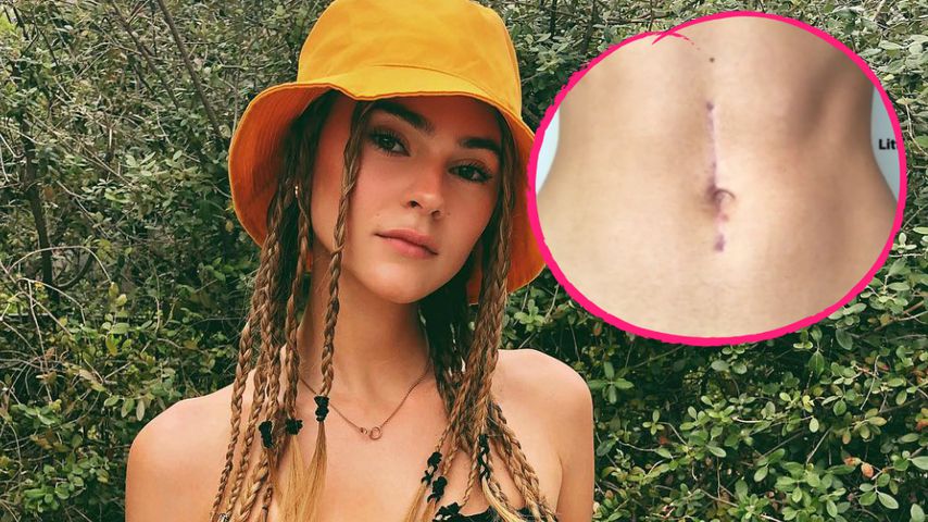 Über zwei Monate nach OP: Narben-Update von Steffi Giesinger