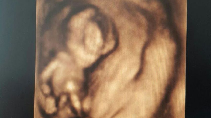 Ultraschallbild von Nadine Zuckers Baby