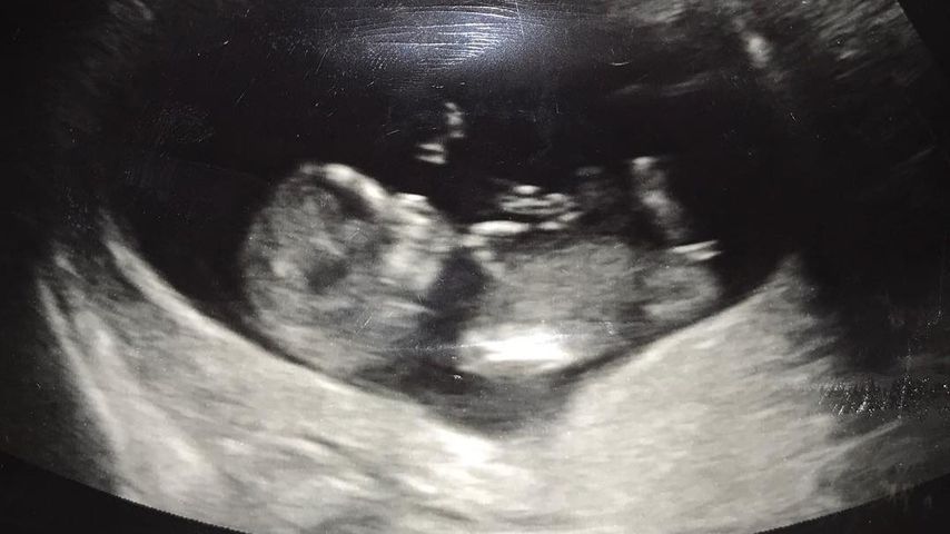 Ultraschallbild von Robin Thickes Baby