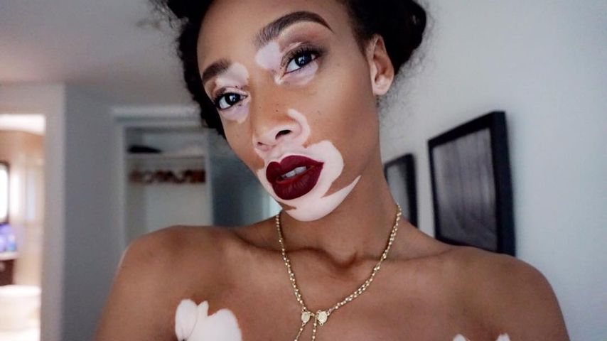 Winnie Harlow in London