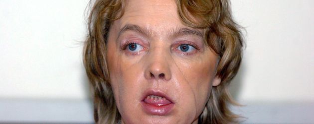 Isabelle Dinoire Isabelle Dinoire