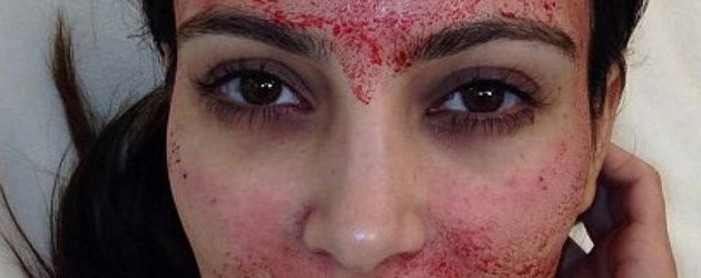 Kim Kardashian nach einem Vampir-Lifting Kim Kardashian nach einem Vampir-Lifting