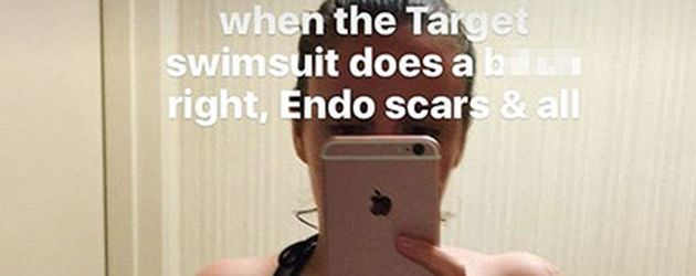 Lena Dunham zeigt ihre Narben Lena Dunham zeigt ihre Narben