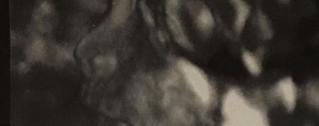 Robert Kardashians und Blac Chynas Baby auf einer Ultraschall-Aufnahme Robert Kardashians und Blac Chynas Baby auf einer Ultraschall-Aufnahme